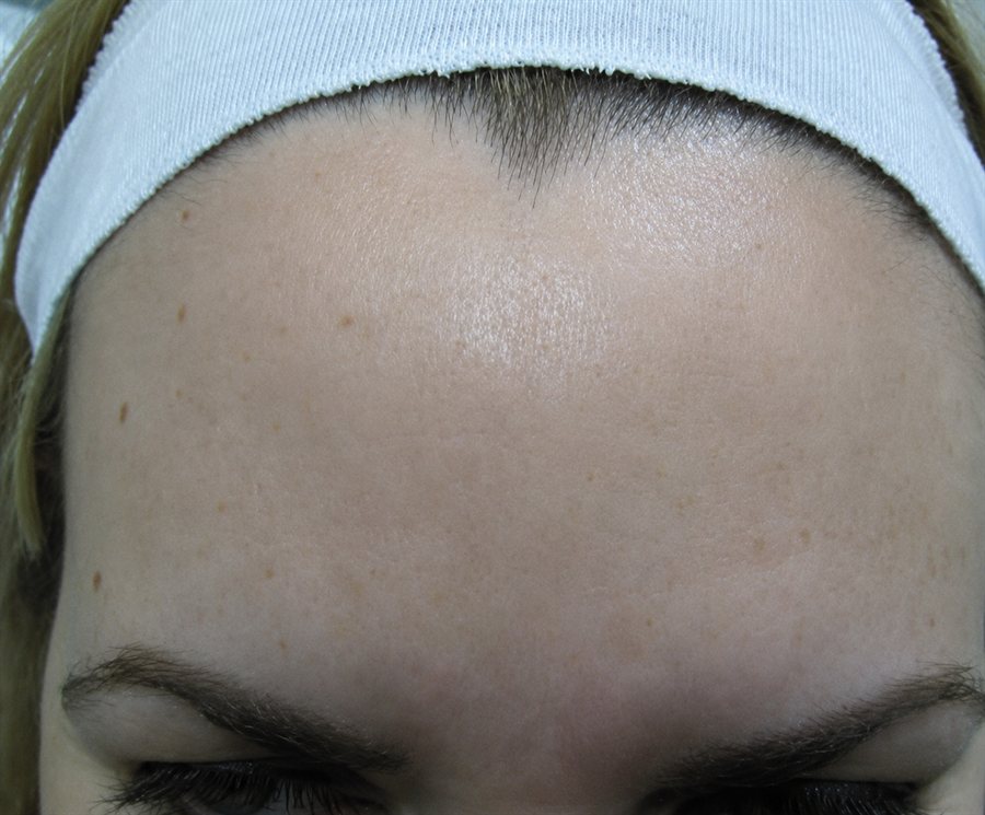 After — forehead lines smoothed with Botox, Glam Medspa Sunnyvale
