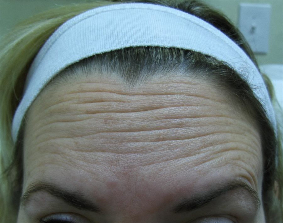 Before — forehead lines smoothed with Botox