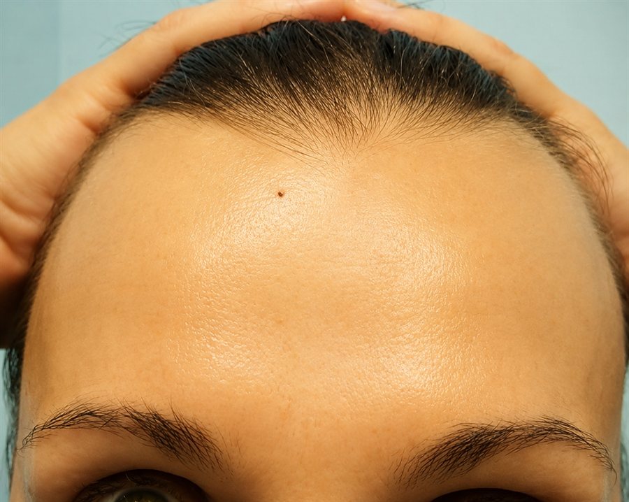 After — forehead wrinkles treated with neurotoxin injections, Glam Medspa Sunnyvale
