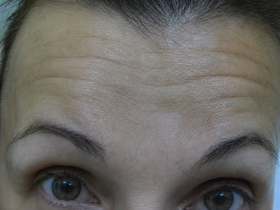 Before — forehead wrinkles treated with neurotoxin injections