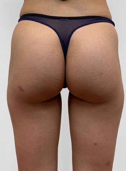 Before — natural volume and lift from non-surgical buttock enhancement