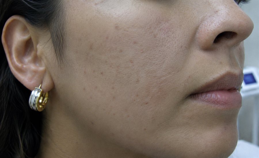 After — skin texture and tone refined with a chemical peel, Glam Medspa Sunnyvale