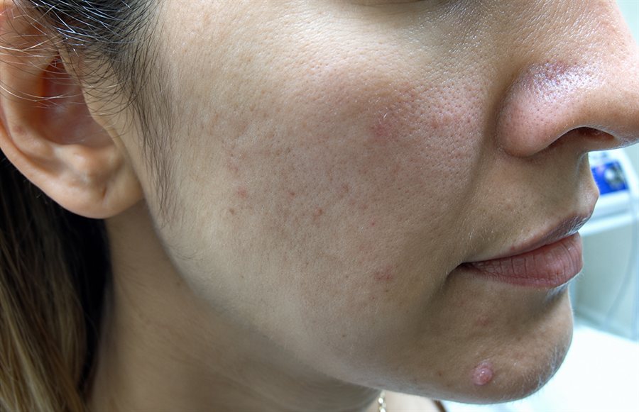 Before — skin texture and tone refined with a chemical peel
