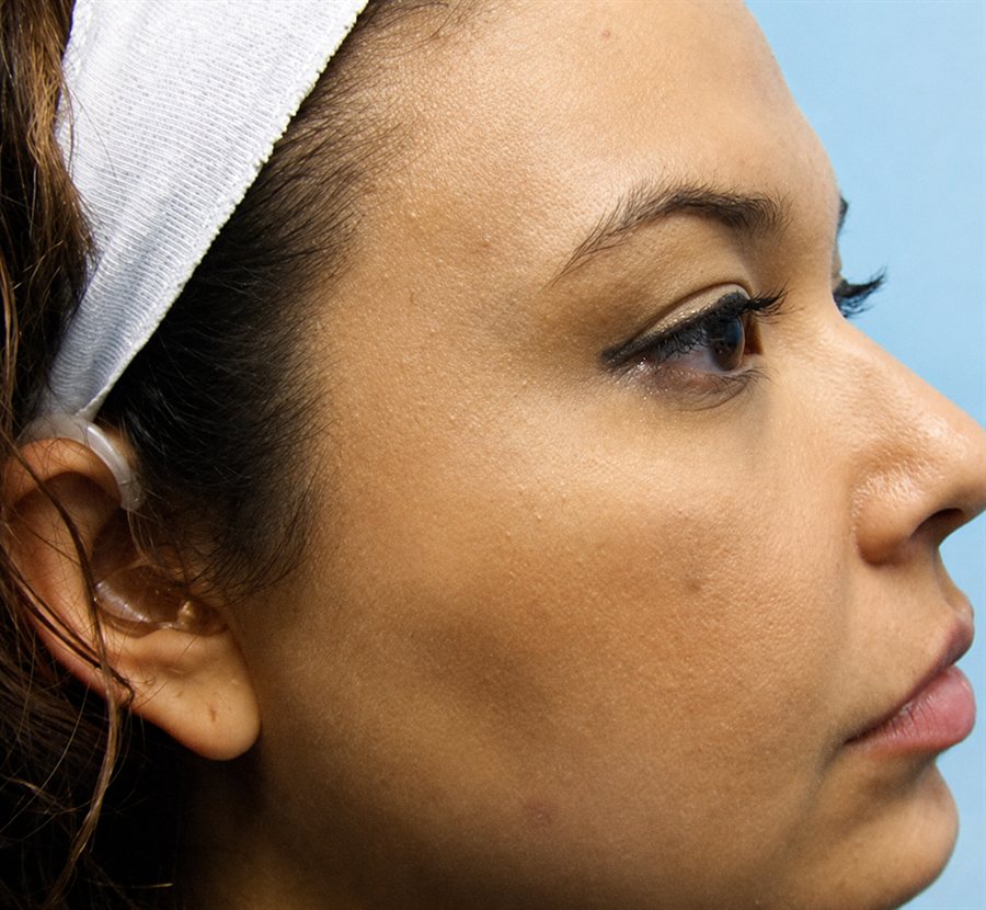 After — acne and blemishes cleared with a chemical peel, Glam Medspa Sunnyvale