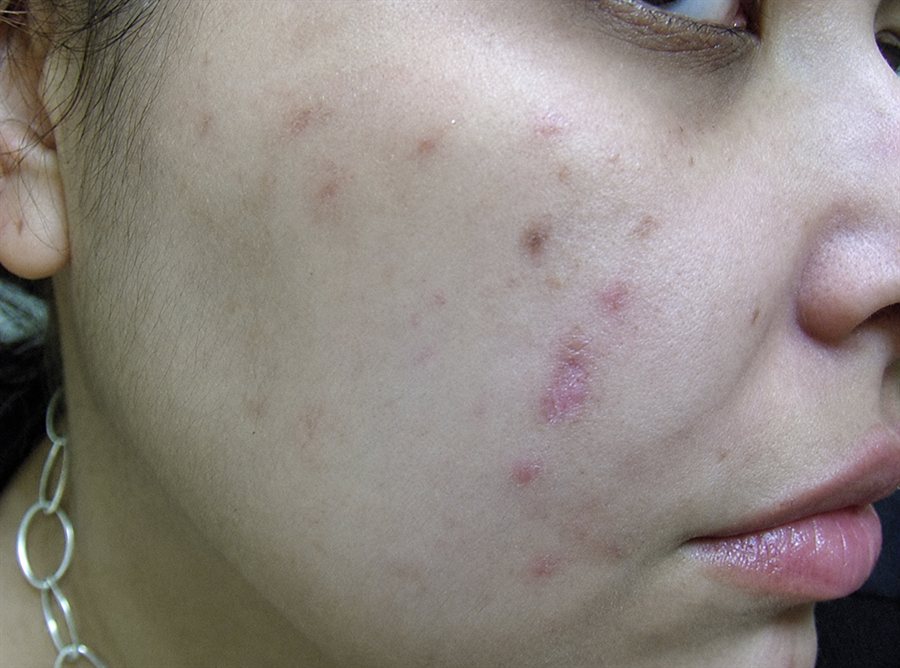 Before — acne and blemishes cleared with a chemical peel