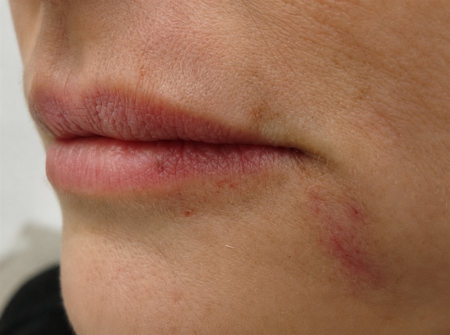 After — lip volume restored with dermal filler, Glam Medspa Sunnyvale