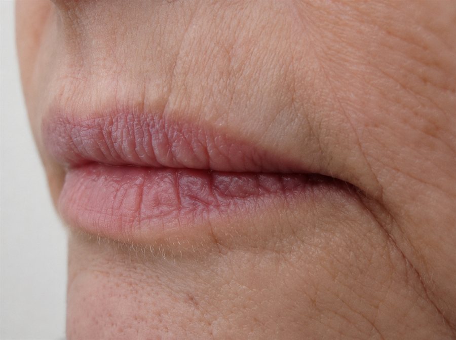 Before — lip volume restored with dermal filler