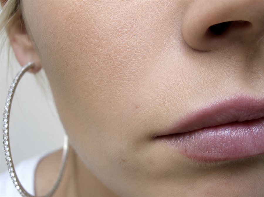 After — lip volume restored with dermal filler, Glam Medspa Sunnyvale