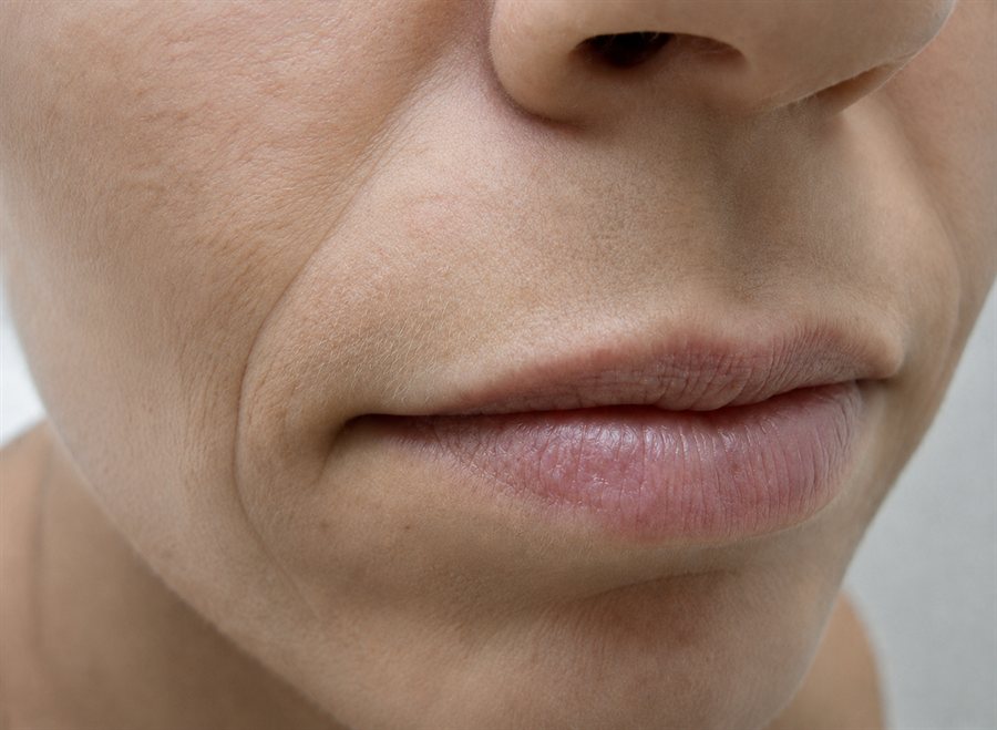 Before — lip volume restored with dermal filler