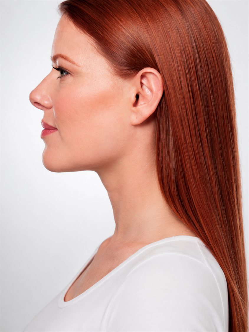 After — jawline contour improved beneath the chin with Kybella, side profile, Glam Medspa Sunnyvale
