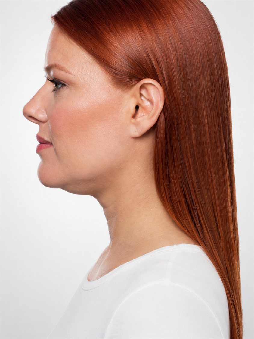 Before — jawline contour beneath the chin, side profile