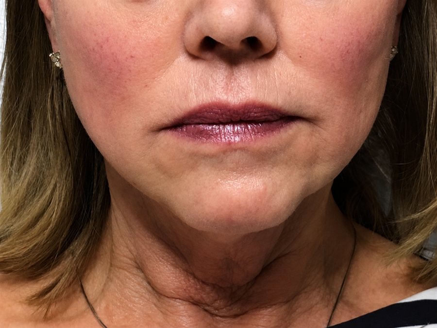 After — jawline and chin contour lifted with PDO threads, Glam Medspa Sunnyvale