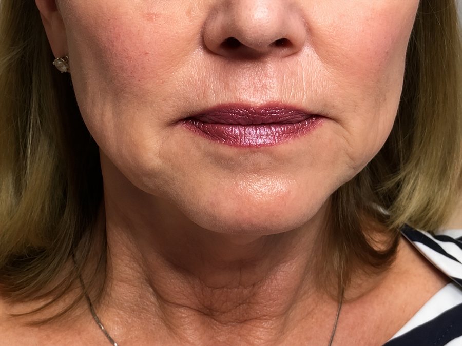 Before — jawline and chin contour lifted with PDO threads