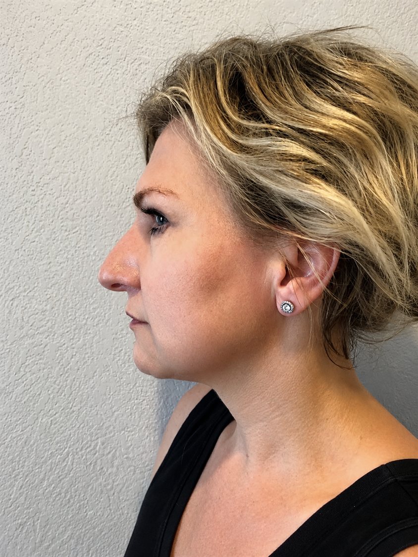After — jawline definition and neck laxity improved with PDO threads, side profile, Glam Medspa Sunnyvale