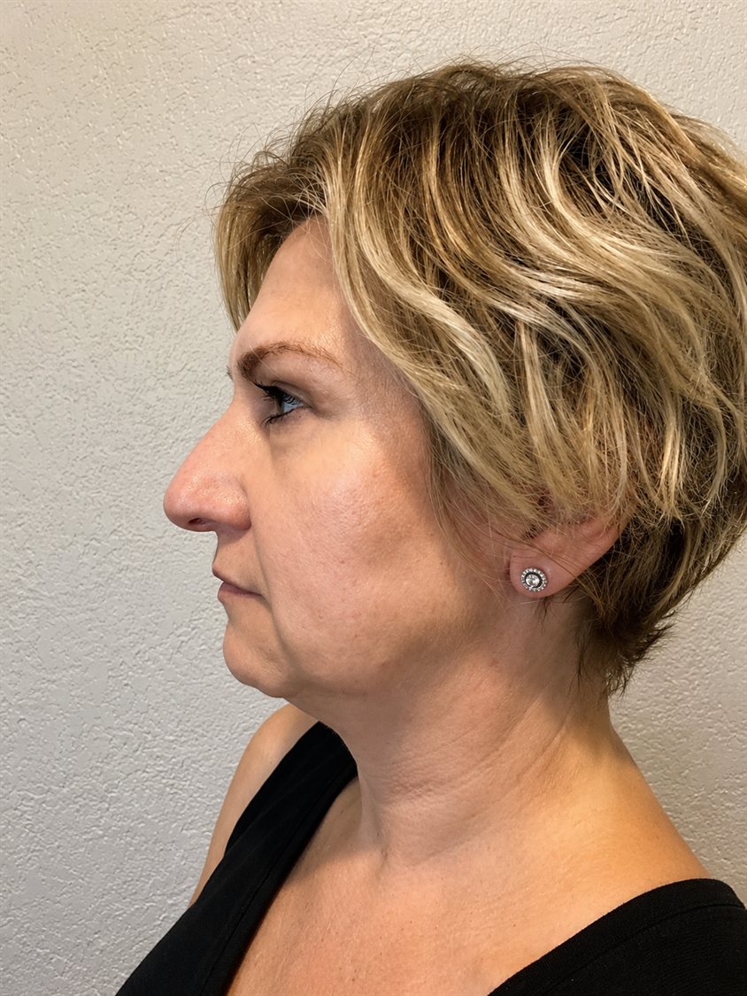 Before — jawline definition and neck laxity improved with PDO threads, side profile