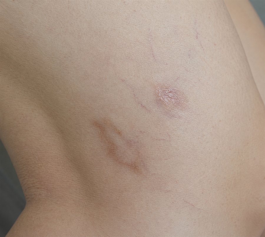 After — thigh spider veins treated with sclerotherapy, Glam Medspa Sunnyvale