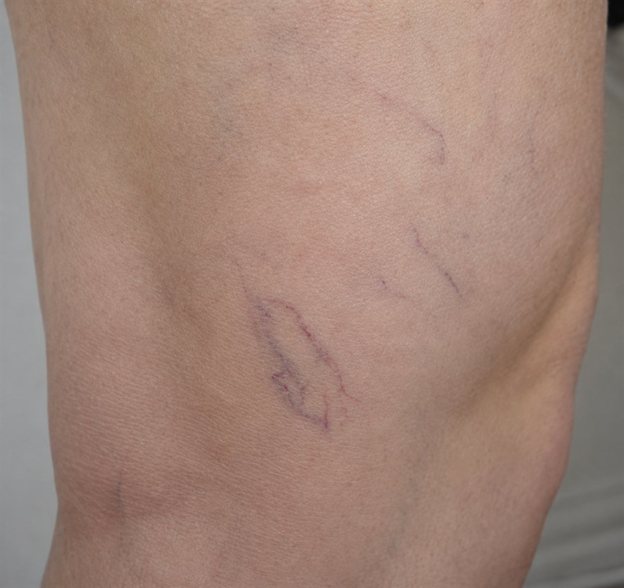 Before — thigh spider veins treated with sclerotherapy