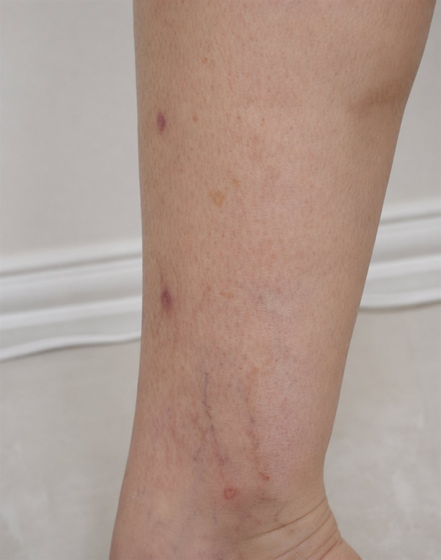 After — ankle veins cleared with sclerotherapy, Glam Medspa Sunnyvale