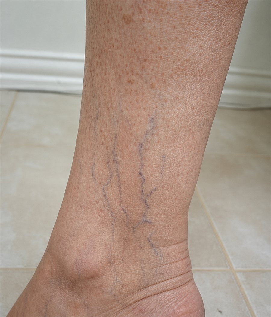 Before — ankle veins cleared with sclerotherapy